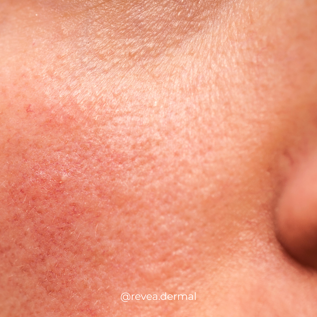 Damaged Skin Barrier: Causes, Signs & Support